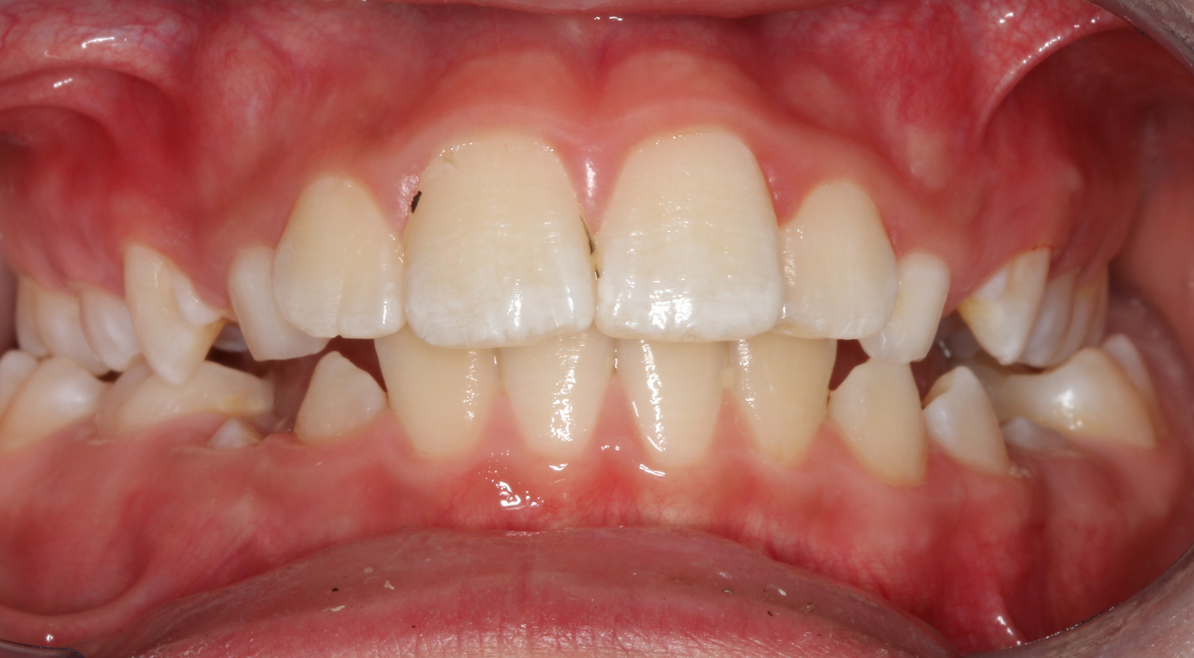 bilateral posterior crossbite case before | SNODGRASS-KING