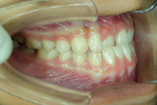 Photo of a crossbite. If your child needs pediatric dentistry in TN Snodgrass-King can help.