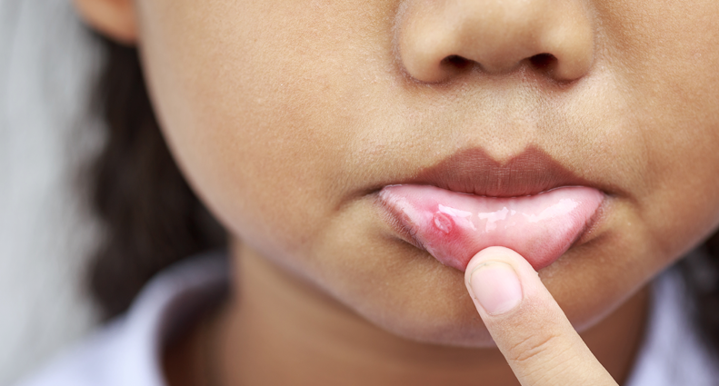 Kids And Canker Sores A Sore Spot In Pediatric Dentistry