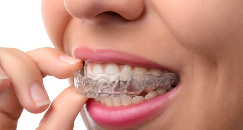 Invisalign® and Clear Braces