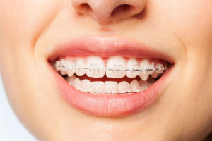 close up picture of ceramic braces in someone's mouth