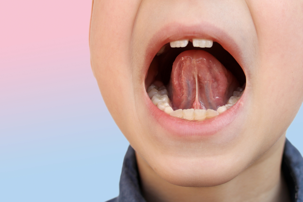 Fix your childs frenum with a frenectomy from Snodgrass-King in Tennessee