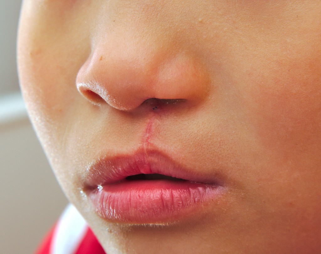 oral - Boy showing a monolateral cleft lip repaired