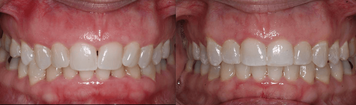 Adult Invisalign case study
