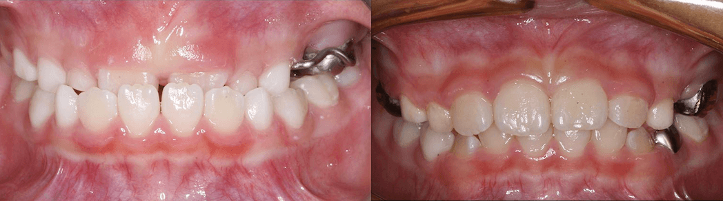 Anterior Crossbite Phase 1 case-study