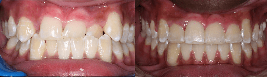 Anterior Crossbite case-study