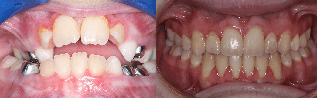 Anterior Openbite & Posterior Crossbite case-study