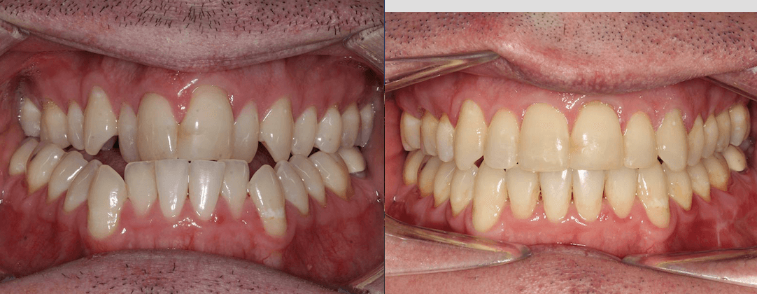 Crossbite & Crowding case-study