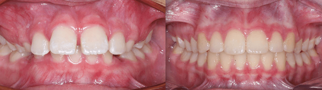Deep Overbite & Excessive Overjet case-study