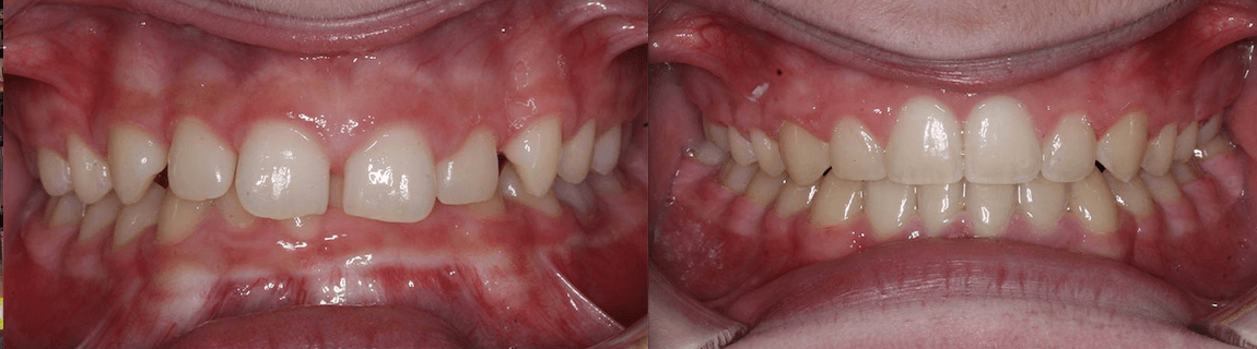 Deep Overbite case study