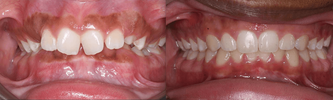 Deep Overbite case study