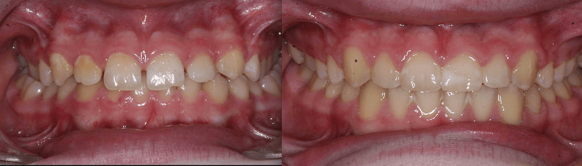 Posterior Crossbite & Spacing case study