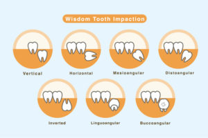 A vector showing seven types of impacted wisdom teeth, including: vertically impacted, horizontal, mesioangular, distoangular, inverted, linguoangular, and buccoangular impacted wisdom teeth.