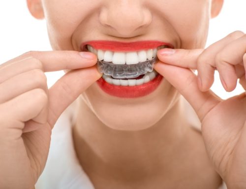 Debunking 4 Myths About Invisalign
