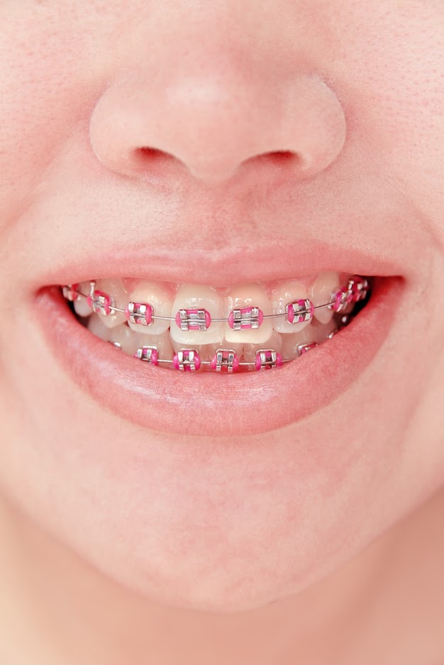 child braces from Snodgrass-King pediatric dentistry in tennessee