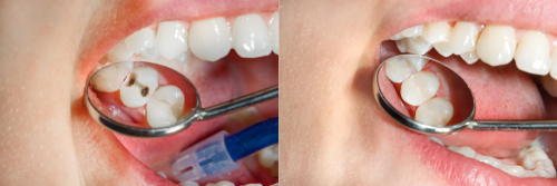 Pediatric dental filling, before and after photo