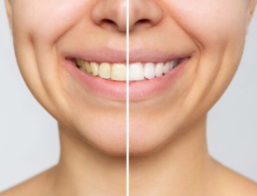 Causes for Yellow Teeth and How to Avoid Them